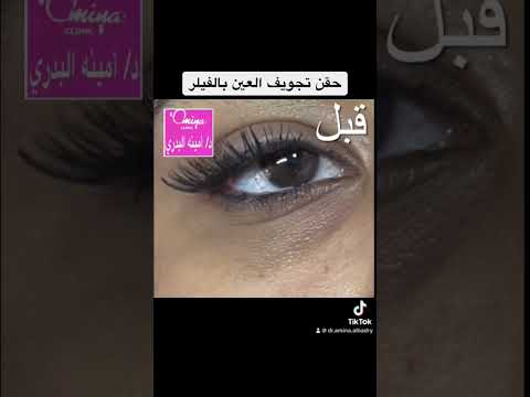 حقن تجويف العين بالفيلر