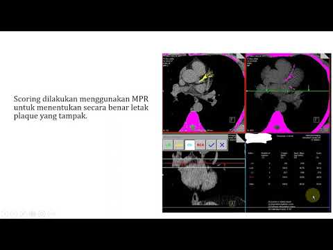 Video: Efek Bixalomer Pada Kalsifikasi Arteri Koroner Pada Pasien Hemodialisis Dengan Hiperfosfatemia: Uji Multi-pusat, Acak Terkontrol