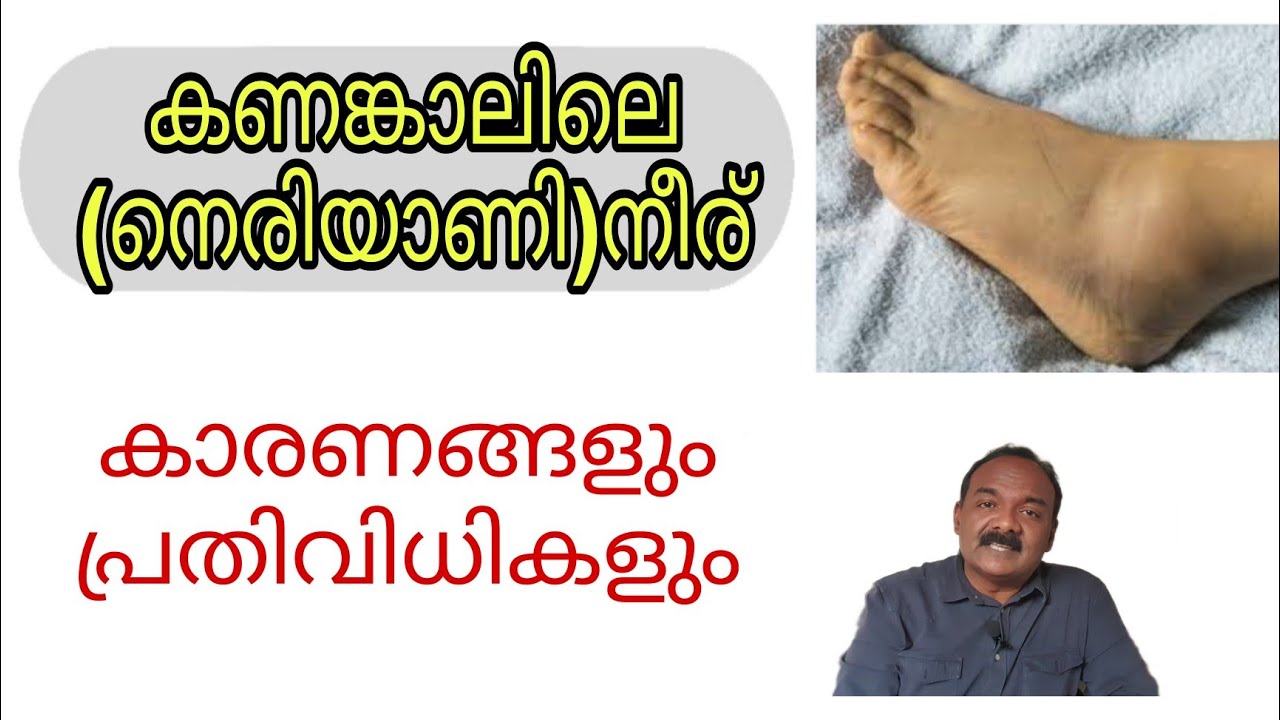കണങ്കാലിലെ നീര്  | നെരിയാണി നീര് | Pedal oedema |Ankle Oedema |Swollen Ankle