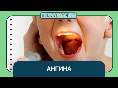 #НАЗДОРОВЬЕ: ангина