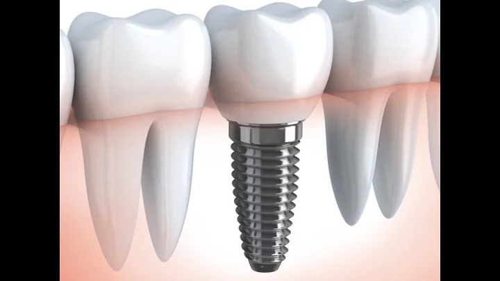 This is Key to the Dental Implant Process  export