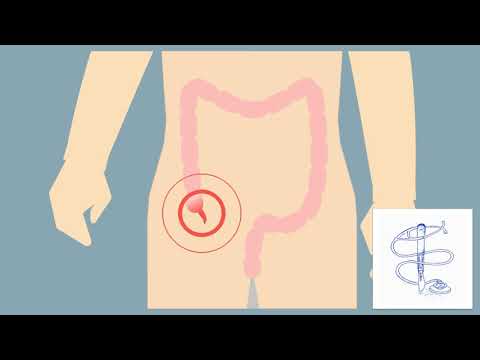 Vidéo: Douleur Au-dessus De La Hanche Gauche Sur Le Côté, Le Dos Et L'abdomen: Causes Et Traitement