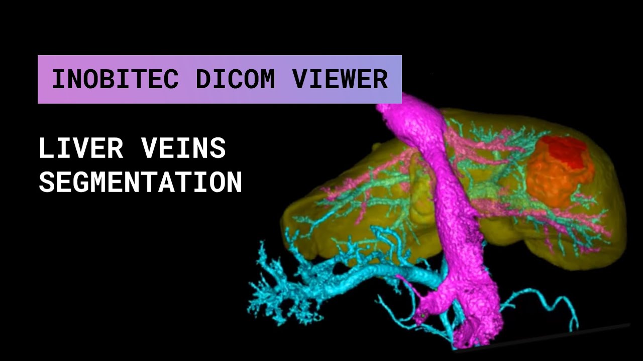 Liver veins segmentation in Inobitec DICOM Viewer Pro 2.3