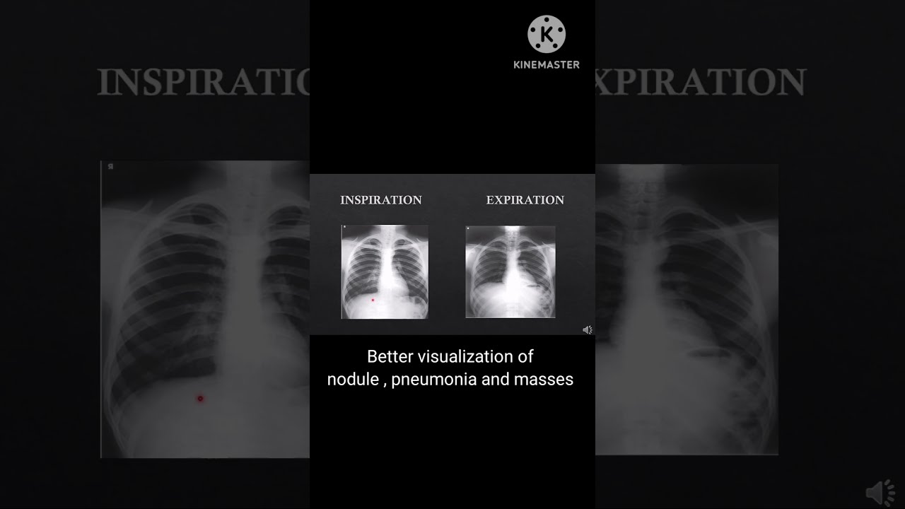 Comparison Of Chest X Ray In Inspiration And Expiration Medicalimaging Xrays Chestimaging