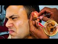 Most Satisfying Ear Wax Removal 😳Extreme Ear Cleaning Transformation🔥 | ASMR Ear Cleaning for Sleep😴