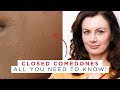 The mostasked questions about closed comedones  answered   dr sam bunting