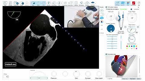 TEE assessment - left atrial appendage - important tips