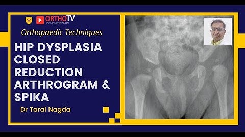 Orthopedische technieken: heupdysplasie gesloten reductie artrogram & spika Dr Taral Nagda