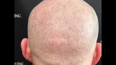 Natural light fade with Scalp Micropigmentation