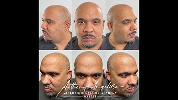 Masterful Macro Shot: Scalp Micropigmentation by Anthony