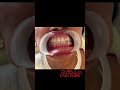 Removable  partialdenture design | Removable partial denture prosthesis |missing back teeth? #viral