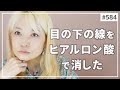 【584】目の下の線（たるみ？クマ？）をヒアルロン酸注射で消した