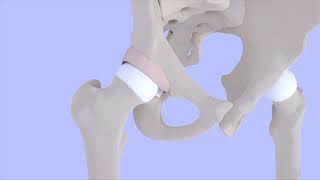 Femoroacetabular Impingement Syndrome