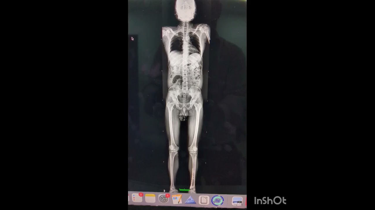 whole body xray