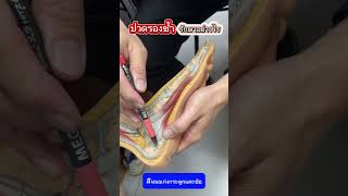 ปวดรองช้ำ รักษาอย่างไร?  #หมอเก่งกระดูกและข้อ #ปวดส้นเท้า #ปวดรองช้ำ #รองช้ำ #ส้นเท้า #พังผืดฝ่าเท้า screenshot 5