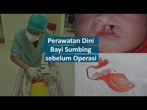 Bibir Sumbing Bayi baru lahir - butuh perawatan dini Dokter Bedah Mulut Semarang Drg Frans Praba