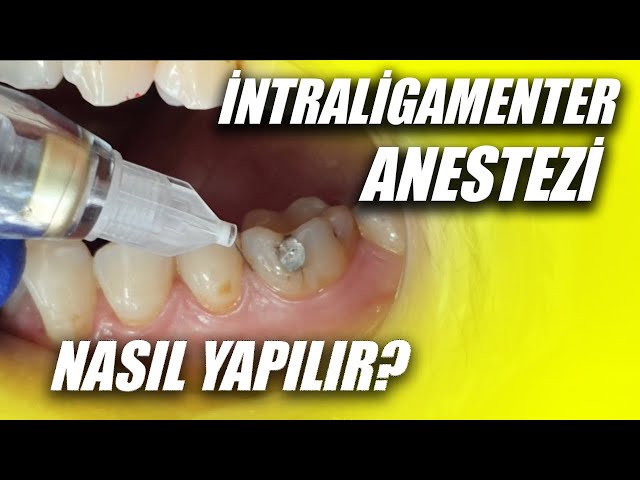 İntraligamenter Anestezi Nasıl Yapılır? Diş Uyuşturma Nasıl Yapılır? Dişe Anestezi Nasıl Yapılır? class=