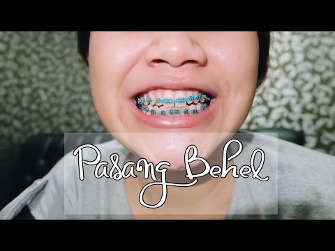  Warna  Karet  Behel  Yang Cocok Untuk Kulit Sawo Matang Ide 