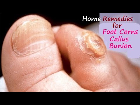 Red Bumps on the Top of My Foot | LIVESTRONG.COM