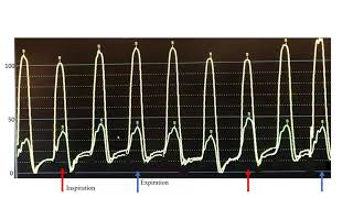 Hemodynamics: Constrictive pericarditis cases, mechanisms, technical tips- Elias Hanna, Univ of Iowa