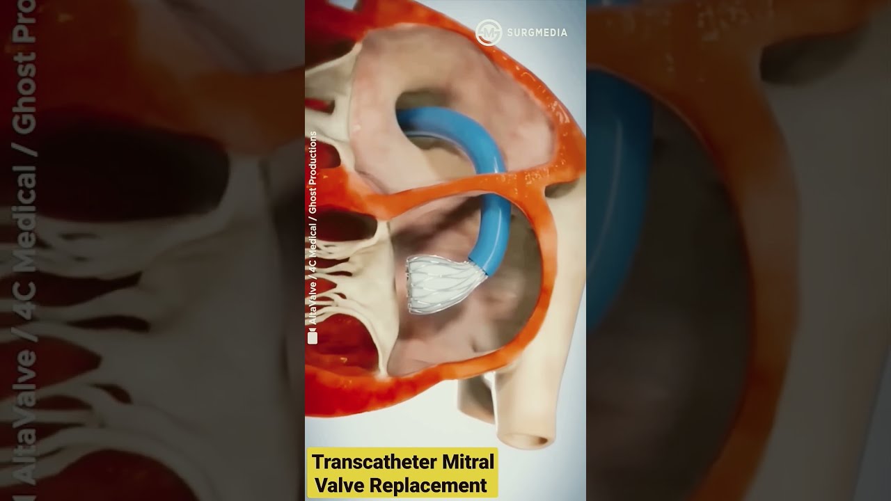 Altavalve Transcatheter Mitral Valve Replacement TMVR Shorts Medical Animation