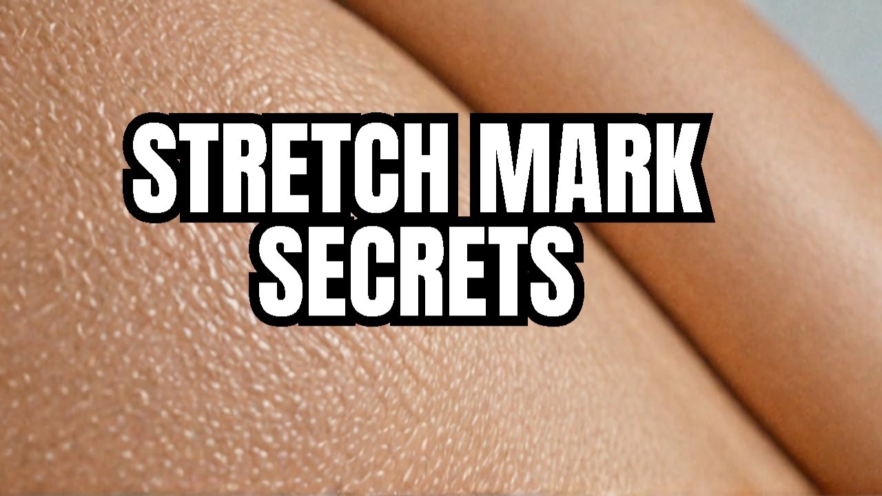 Your Stretch Marks Reveal This About Your Body