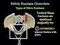 Pelvic Fracture Overview - Everything You Need To Know - Dr. Nabil Ebraheim