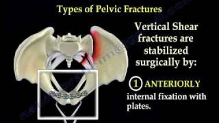 Pelvic Fracture Overview - Everything You Need To Know - Dr. Nabil Ebraheim