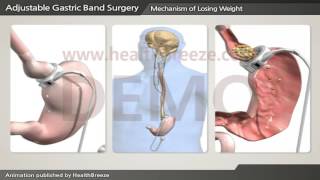 [시연용] c0201aaen Adjustable Gastric Band Surgery