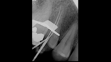 scouting 2-1-2 in endodontics