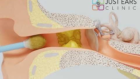 Why you should not use cotton buds to clean your ears