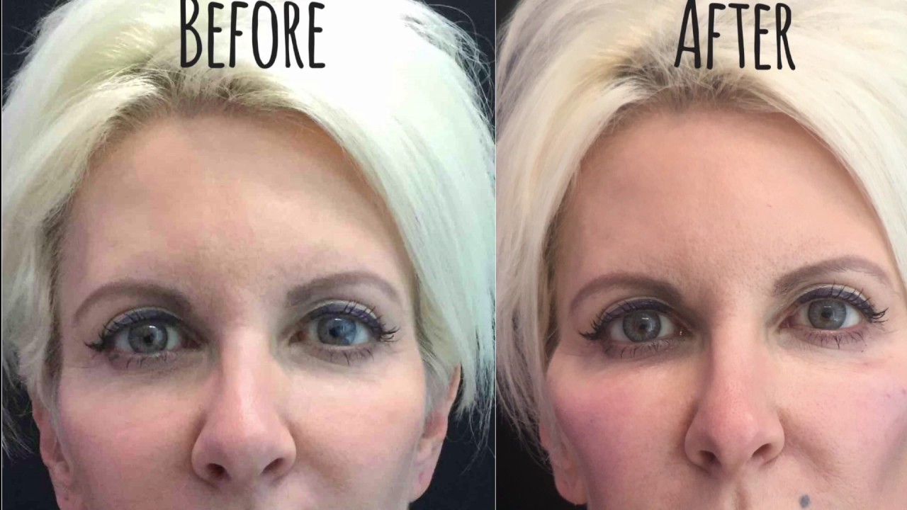 Before and After - Fillers for Cheeks & Jawline 