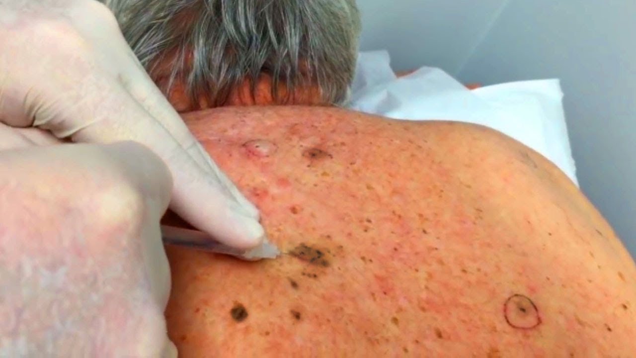Blackheads Dilated of Winer, Revisited - YouTube
