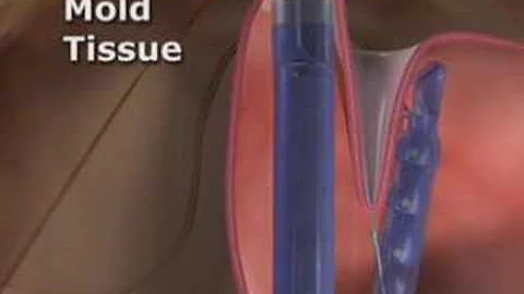 Che significa cardias in sede Beante?