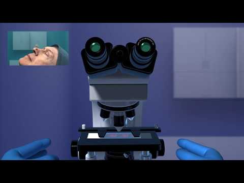 Video: Mohs Kirurgi: Hur Lång Tid Det Tar Och återhämtning