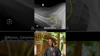 How to Read an Axillary Shoulder X-Ray Like Pro | X-Ray Basics
