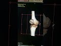Fracture de patilla TDM Genou #mri #genoux #industrialelectrician #tdm #scanners