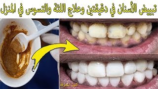 عاجل: مكون عجيب يجعل الأسنان بيضاء لامعة كاللؤلؤ ويعالج اللثة وآلامها والتسوس وفطريات الفم في المنزل