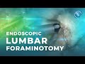 What is endoscopic lumbar foraminotomy