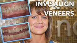 Do INVISALIGN first! MUST watch before getting DENTAL VENEERS!   (EP 05 Cosmetic Dentistry) 