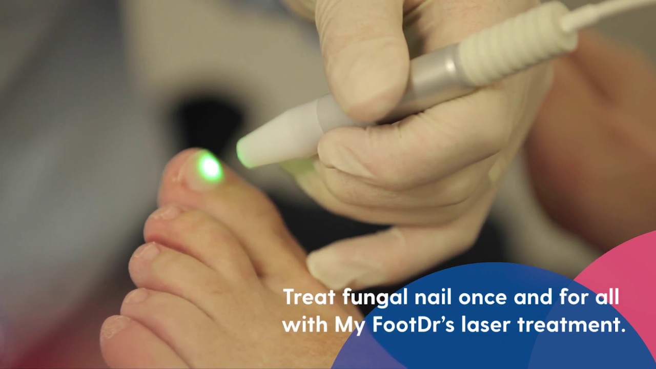 Laser Toenail Fungus - When Should My Child See a Podiatrist?