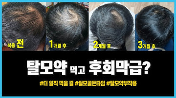 탈모약 먹고 후회막급? [탈모극복 후기] 프로페시아 복용 3개월, 더 일찍 먹을 걸 | M자탈모 정수리탈모 초기 | 탈모약 부작용