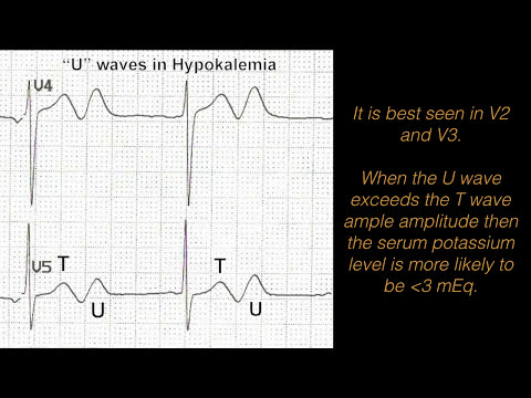 hypokalemia---what-are-the-ekg-changes-associated-with-it?