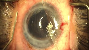 DMEK corneal transplant following previous failed grafts