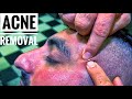 ASMR ACNE REMOVAL AND ASMR MASSAGE • Cleanliness and comfortable sleep • Sivilce Temizleme