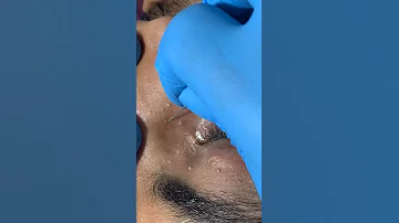 How Much Do You Know About Milia Removal Milia Removal At Skinaaclinic Milia Removal Miliaremoval 