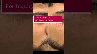 How Much Do You Know About Milia Removal? Milia Removal At Skinaaclinic 