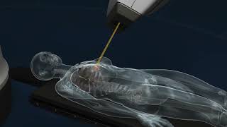 Motion-Synchronized Radiation Therapy