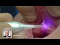 Nv pro3 microlaser procedures  frenectomy technique  denmat dental education