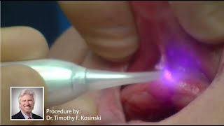NV® PRO3 Microlaser Procedures - Frenectomy Technique - DenMat Dental Education